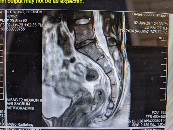 Scan of Lucy Stirling's injury